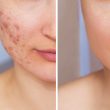 Cropped shot of a young woman's face before and after acne treatment. Pimples, red scars on the girl's cheeks. Problem skin, care and beauty concept. Dermatology, cosmetology