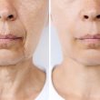 Lower part of face and neck of a caucasian elderly woman with signs of skin aging before after facelift, plastic surgery. Age-related changes, flabby saggy skin, wrinkles, creases. Rejuvenation